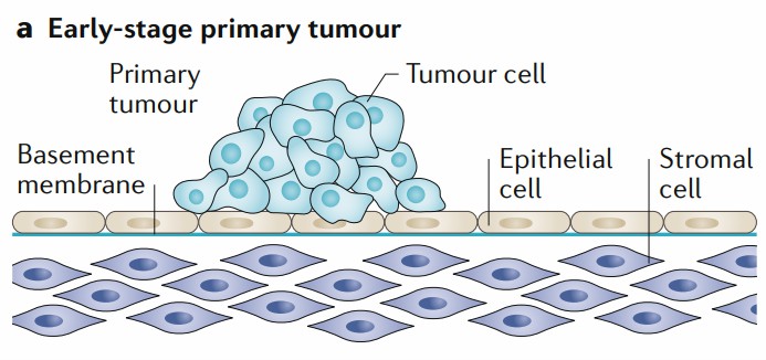 Orthotopic breast cancer in situ chip.