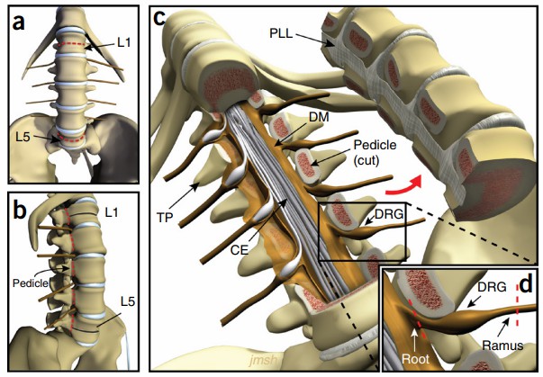 Surgical extraction of human DRG using ventral approach.