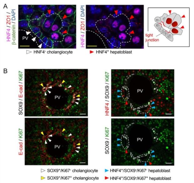 Morphological characteristics of cells in the lumen of the bile duct.