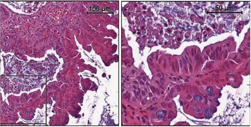 Histological features of neoplastic colon tissue in organ culture.