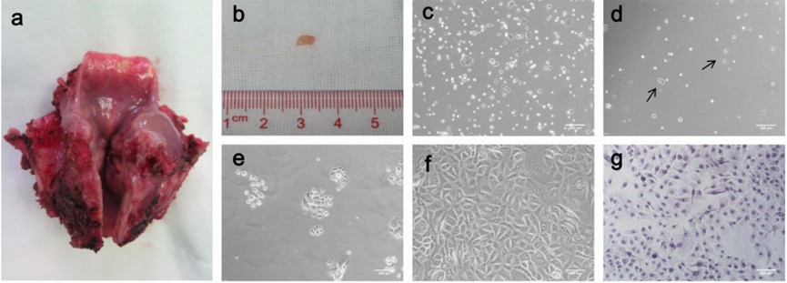 Laryngectomy tissue sample.