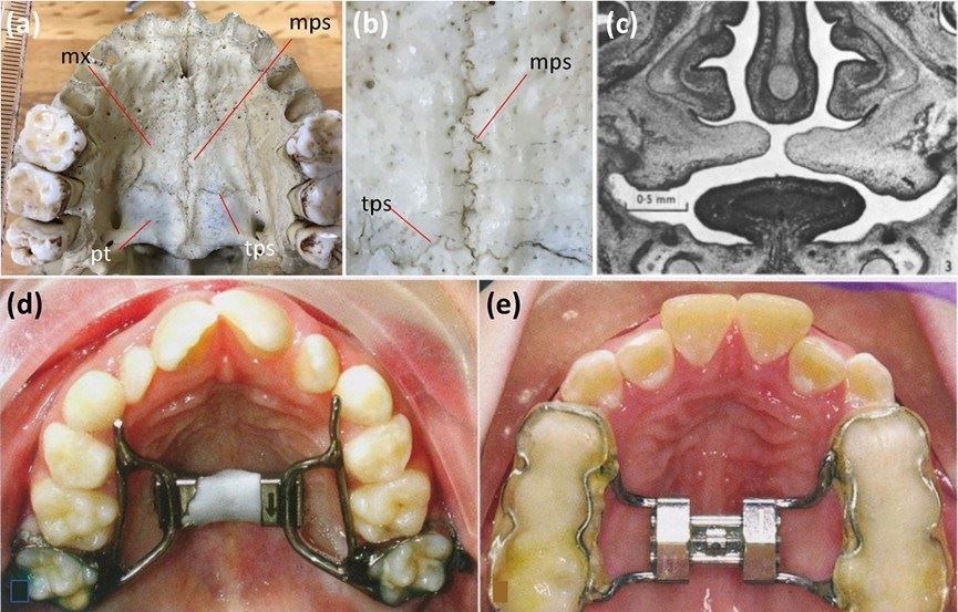 Anatomy of the palatal suture.