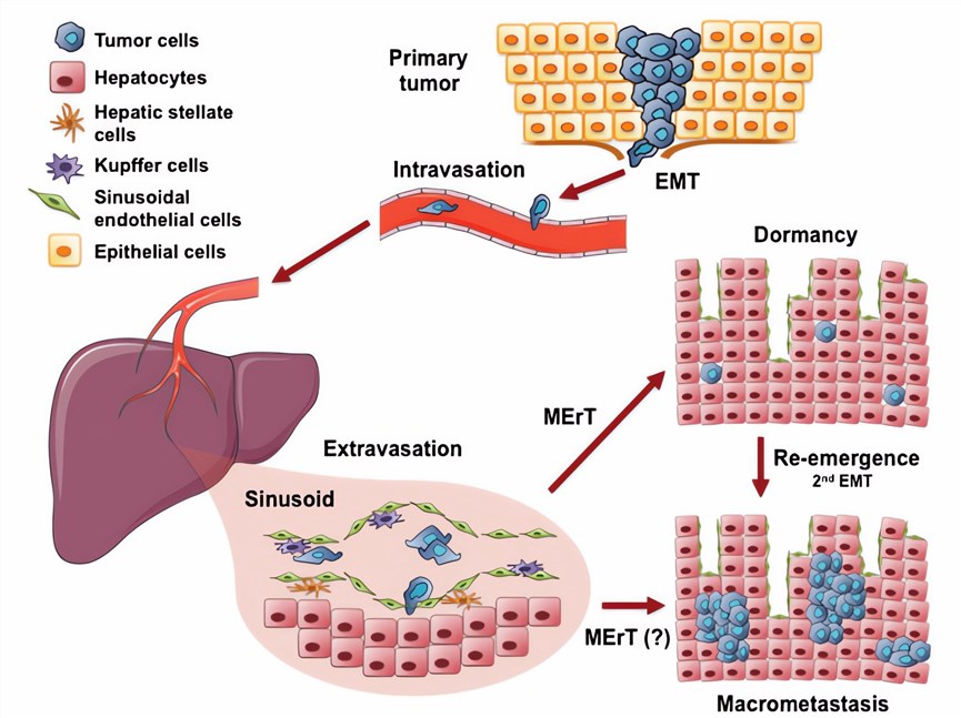 Metastatic cascade to the liver.