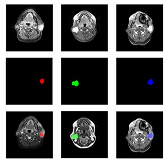 MRI image of parotid tissue. (Chang, 2021)