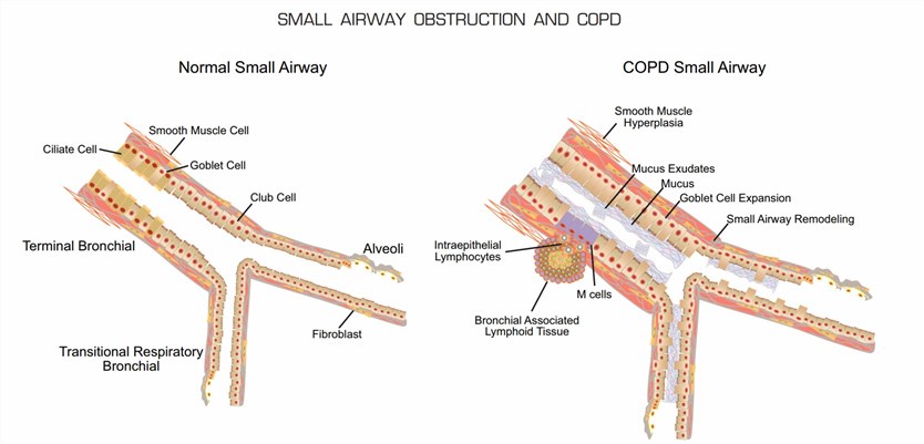 Structural alterations that can be seen in the small airways in COPD.