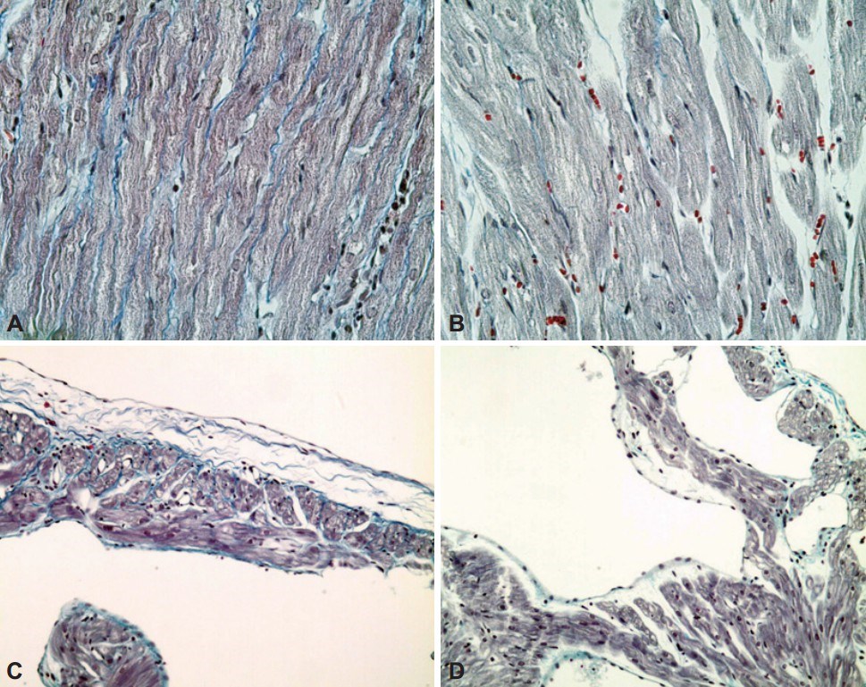 Heart failure cardiac tissue model.