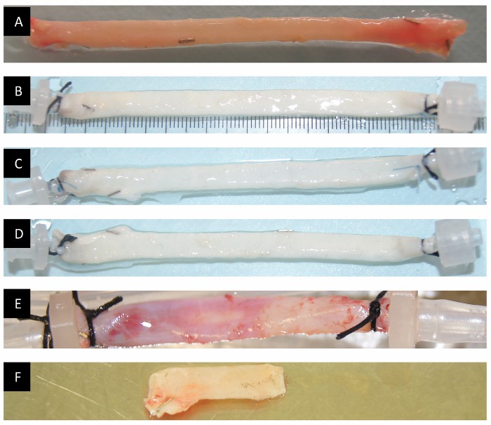 Human saphenous veins after decellularization and recellularization.