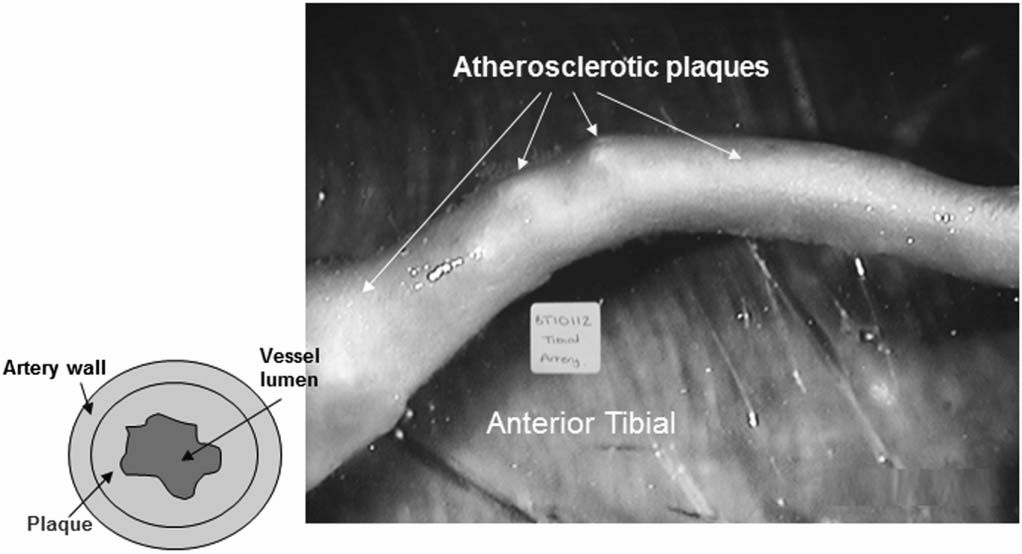 Atherosclerotic tissue sample.