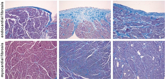 Atrial fibrosis in endocardium and myocardium.