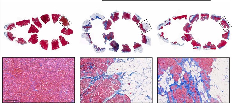 Arrhythmogenic cardiomyopathy tissue.