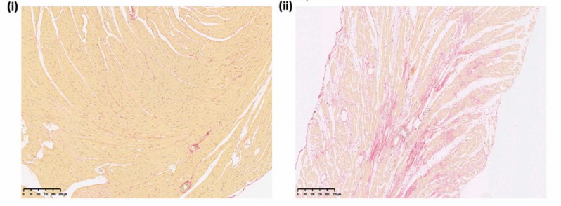 Fibrosis of ventricular cells. (Saadeh, 2021)