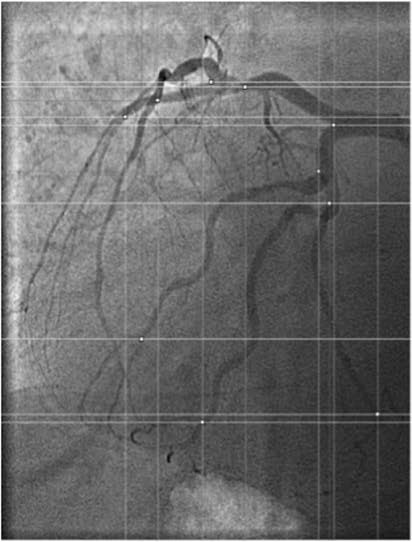 Human coronary artery with side branches. (Vardhan, 2019)