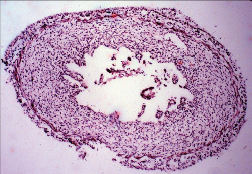 Paravesical portion of ureter.