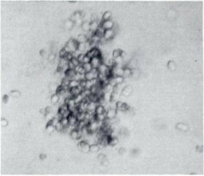 Appearance of lymphoid colony on an agar plate. (Smith, 1978)