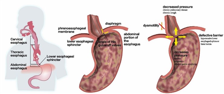 Disruption of the anti-reflux barrier at the esophageal junction. (Zheng, 2021)