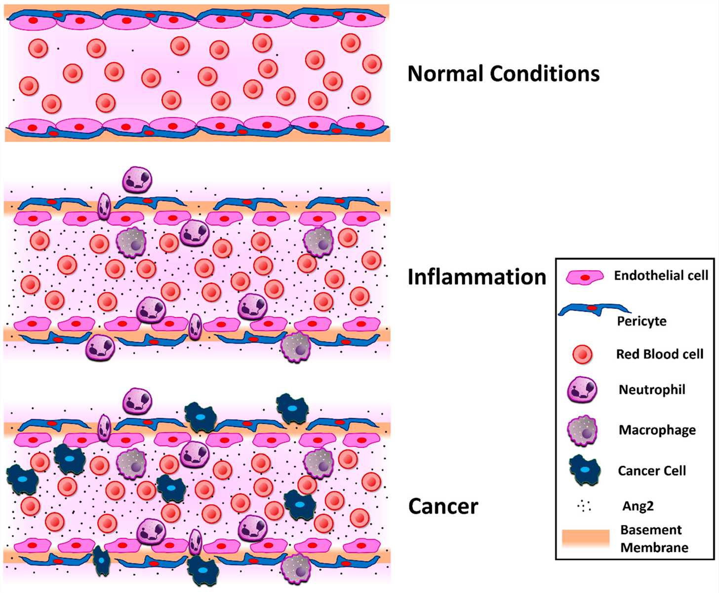 Schematic representation of the Ang2 effect on the vascular bed in normal conditions, inflammation, and cancer (Akwii RG, 2019)