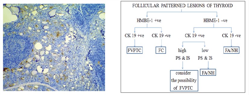 Ivd Antibody Immunoassay Development Services For Hbme 1 Biomarker Creative Biolabs