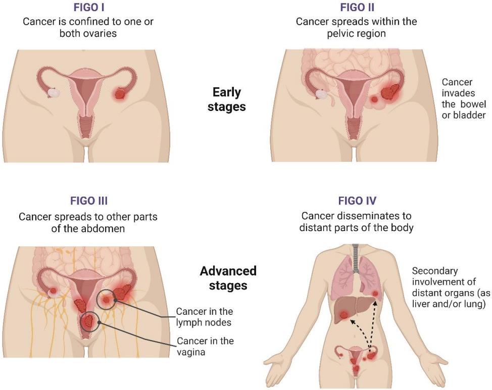 Fig.1 Ovarian cancer stages. (Tavares, et al., 2024)