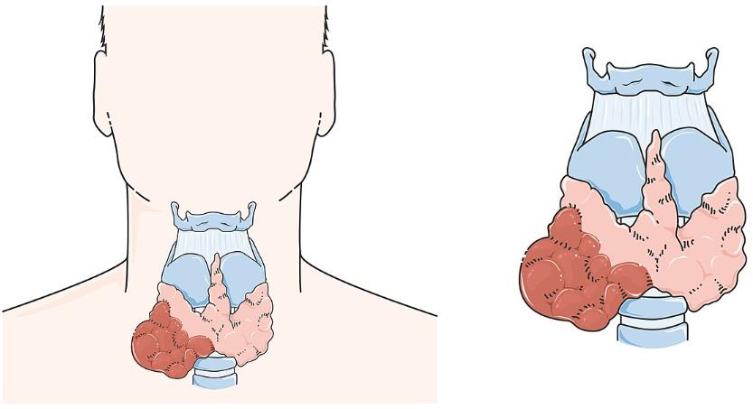 Fig.1 The thyroid cancer. (https://commons.wikimedia.org/wiki/File:Thyroid_cancer_--_Smart-Servier.jpg)