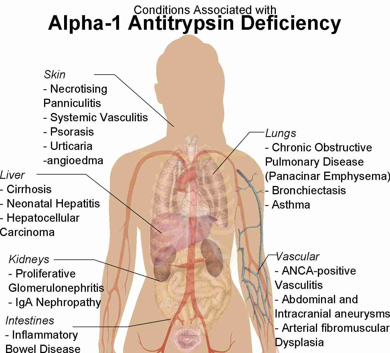 Fig. 1 Human female shadow diagram with conditions associated with Alpha-1 Antitrypsin Deficiency.