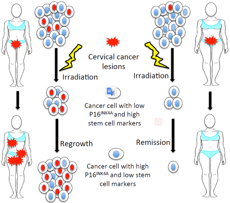 Fig.2 Low P16INK4A expression associated with high expression of cancer stem cell markers predicts poor prognosis. (Fu, et al., 2018)