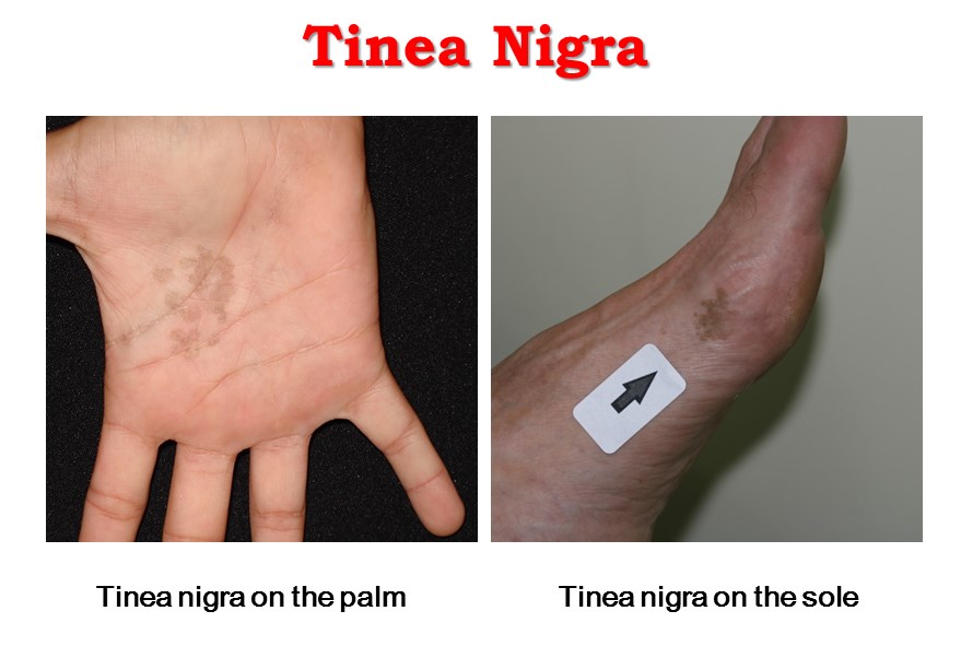 Tinea Nigra Plantaris (3), tinea