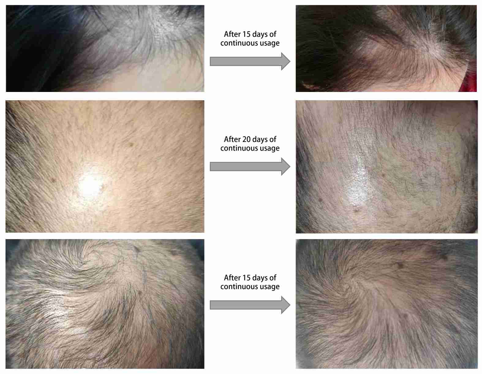 Fig.3 UCMSC exosomes effect on hair. (Creative Biolabs Original)