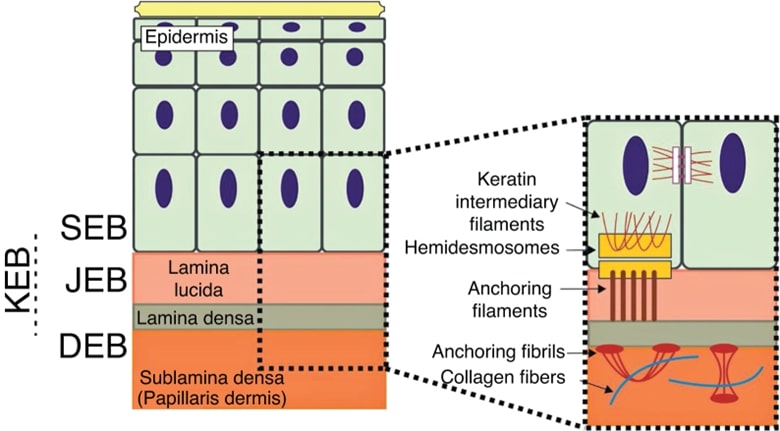 Schematic representation of the skin layers associated with the different types of EB.