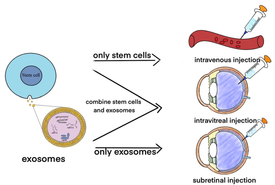 Use stem cells and exosomes to treat retinal disorders.