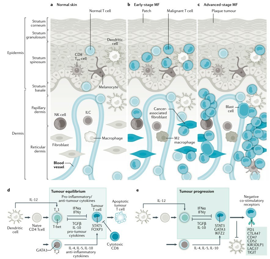 Pathogenesis of mycosis fungoides.