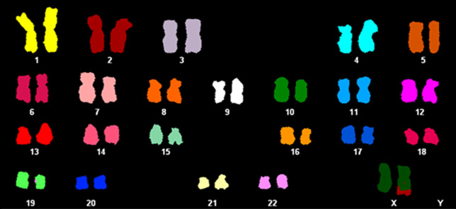 Spectral karyotyping (SKY) of the metaphase spread showing der(X)t(Xq;2p).