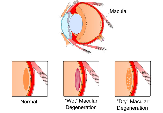 Age related macular degeneration (AMD).