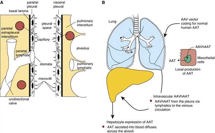 Concept of intrapleural administration of an adeno-associated virus (AAV) vector coding for alpha-1 antitrypsin. 