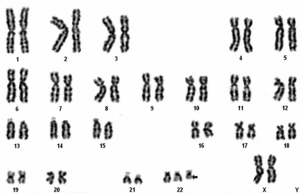 Karyotype of a Baby Showing 47,XX,+idic(22)(q11.2) or 47,XX,+idic(22)(pter−>q11.2::q11.2−>pter) Suggestive of CES (Sharma D, 2014)