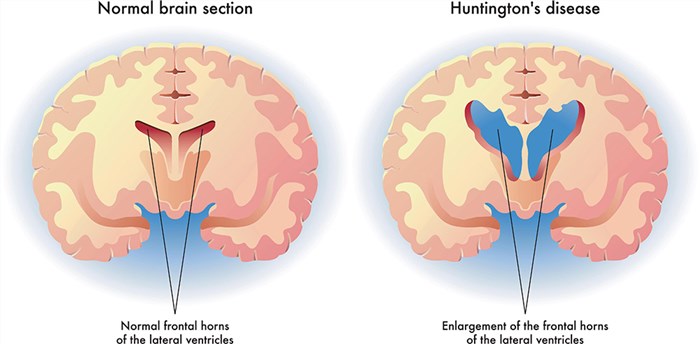 The difference in structure of a normal brain and one with Huntington's disease