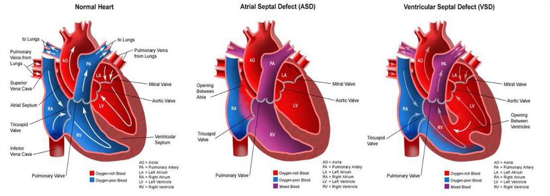 Physiological Mechanism of Congenital Heart Defect Prognosis & Diagnosis