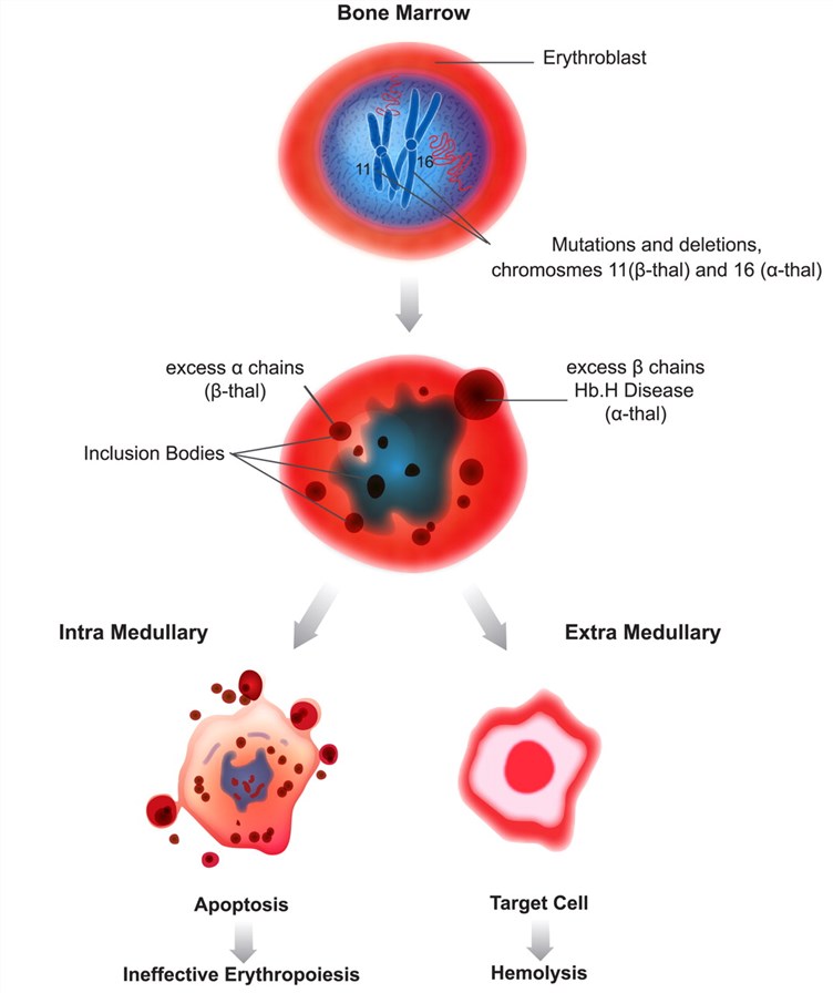 Mechanism of IE and hemolysis in thalassemia. 
