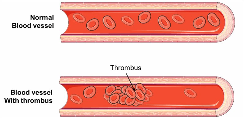 A feature of Thrombophilia