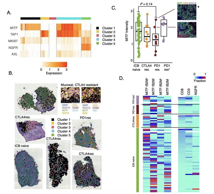 Tumor Cells States in Immune Checkpoint Blockade (ICB) Resistant Melanoma. (Lauss, Martin, et al., 2024)