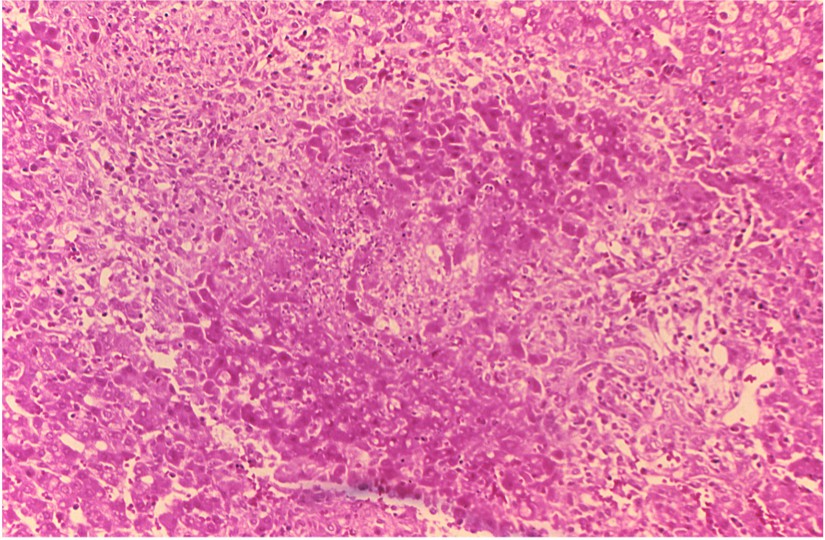 Granuloma and necrosis in the liver of a guinea pig infected with Brucella suis.