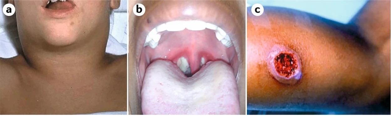 Clinical presentations of diphtheria.