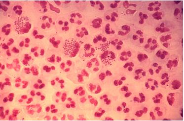 Gram stain of the bacteria N. gonorrhoeae.