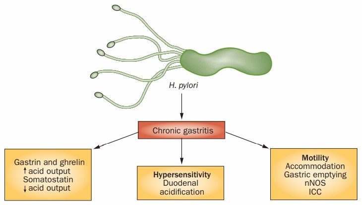 Symptoms of chronic gastritis caused by H. Pylori infection.