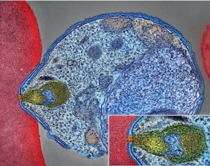 Malaria parasite (blue) attaches to the red blood cell.