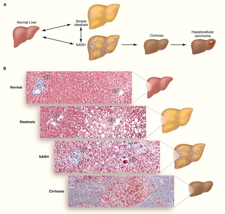 Histologic features of human NASH.