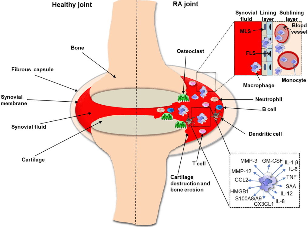 Fig.1 Pathogenesis of RA. (Roszkowski and Marzena, 2021)