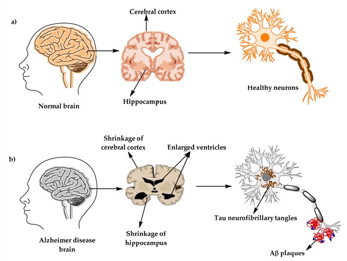 The physiological structure of the brain and neurons in a healthy brain and b AD brain.