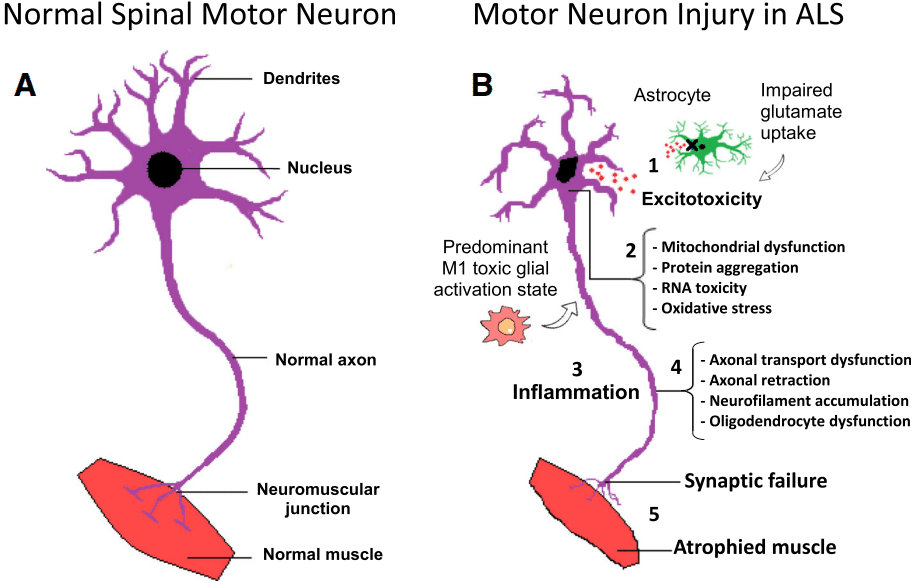 Fig.1 ALS pathophysiology. (Ciervo, et al., 2017)