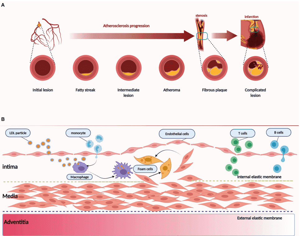 Fig.1 Pathology of atherosclerosis. (Li, et al., 2022)