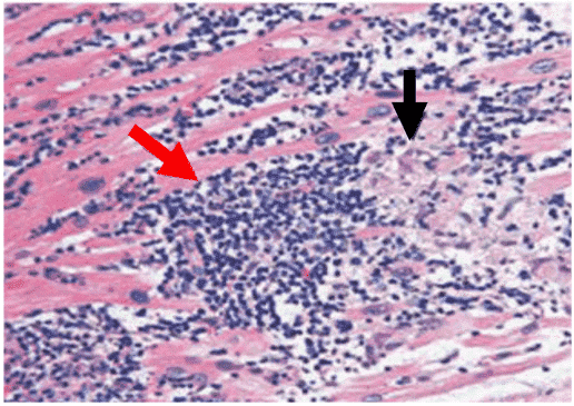 Fig.1 Histopathology of myocarditis. (Nappi and Sanjeet, 2023)